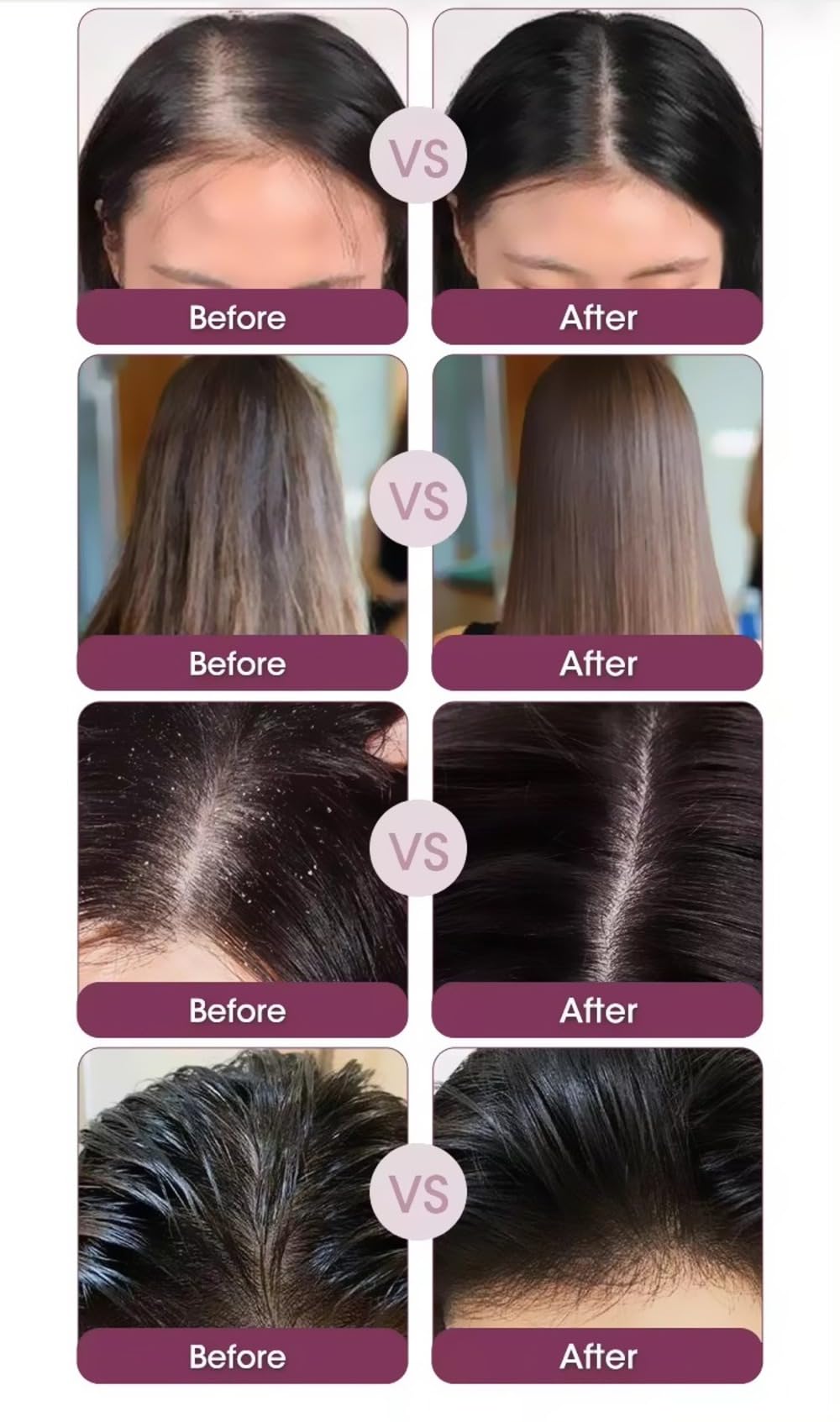 Black Red Onion Shampoo Biotin Keratin 500ml- Anti Hair Loss, Anti Dandruff Shampoo for Hair Growth & Thickening - Salon Grade 100% Vegan, Nourishing Care to Restore Shine Paraben & Sulphate Free