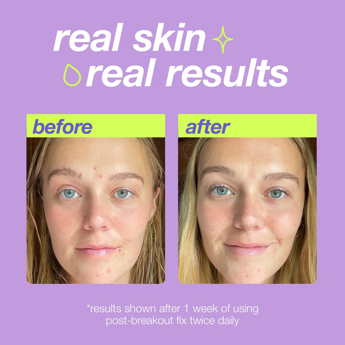 Plum Dermalogica Clear Start Post-Breakout Fix, Acne Dark Spot Treatment with Salicylic Acid, Squalene & Hexylresorcinol, Fade + Brighten Acne Marks