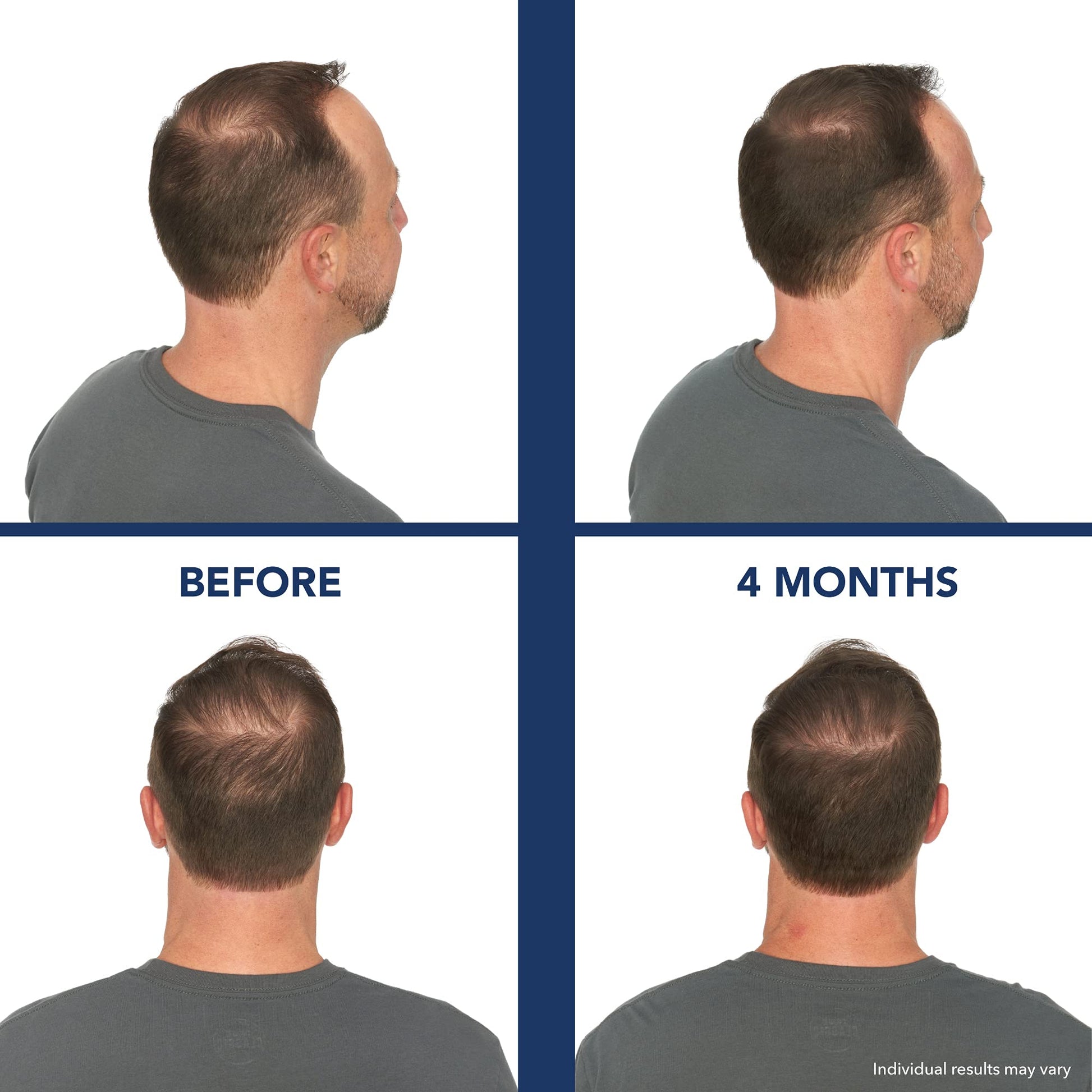White Smoke Bosley Revitalizer 272 Flex 100% Laser No LEDs Hair Growth Cap (LLLT) Men and Women - Regrowth, Home Treatment, Thicker, Fuller, Healthy Hair, FDA Cleared, Large Size