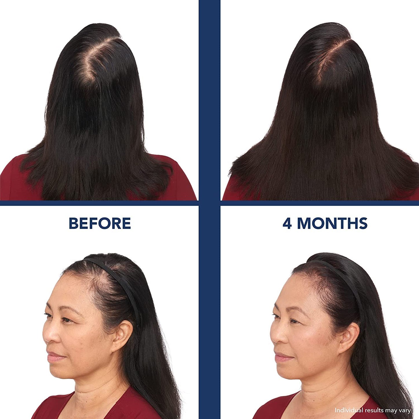 White Smoke Bosley Revitalizer Flex 164 Diode 100% Laser No LEDs Hair Growth Cap (LLLT) Men and Women - Regrowth, Home Treatment, Thicker, Fuller, Healthy Hair, FDA Cleared. Large Size