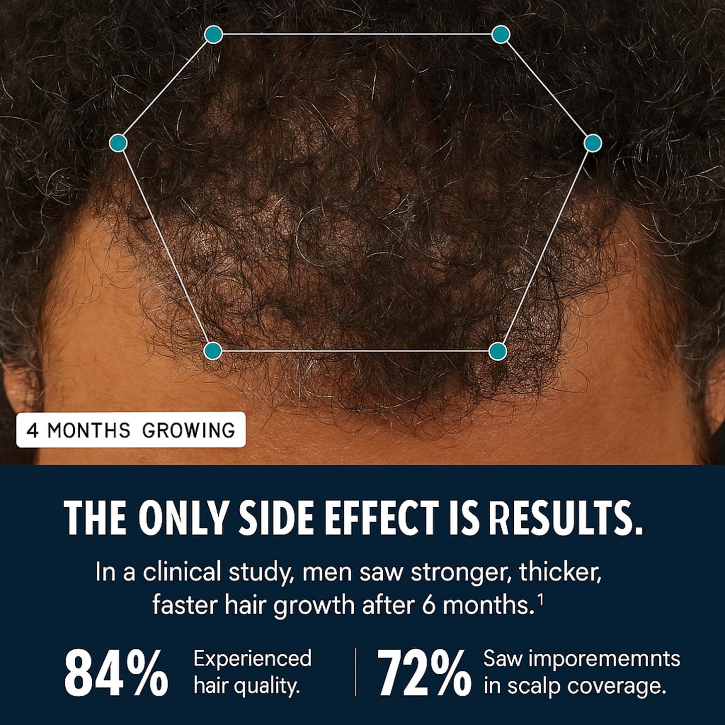 Black Hairfol Men's Hair Growth Supplement – Clinically Tested Hair Growth Vitamins for Men, Thicker Hair & Scalp Coverage, Hair Regrowth Support for Men – Stronger, Fuller Hair – 1 Month Supply