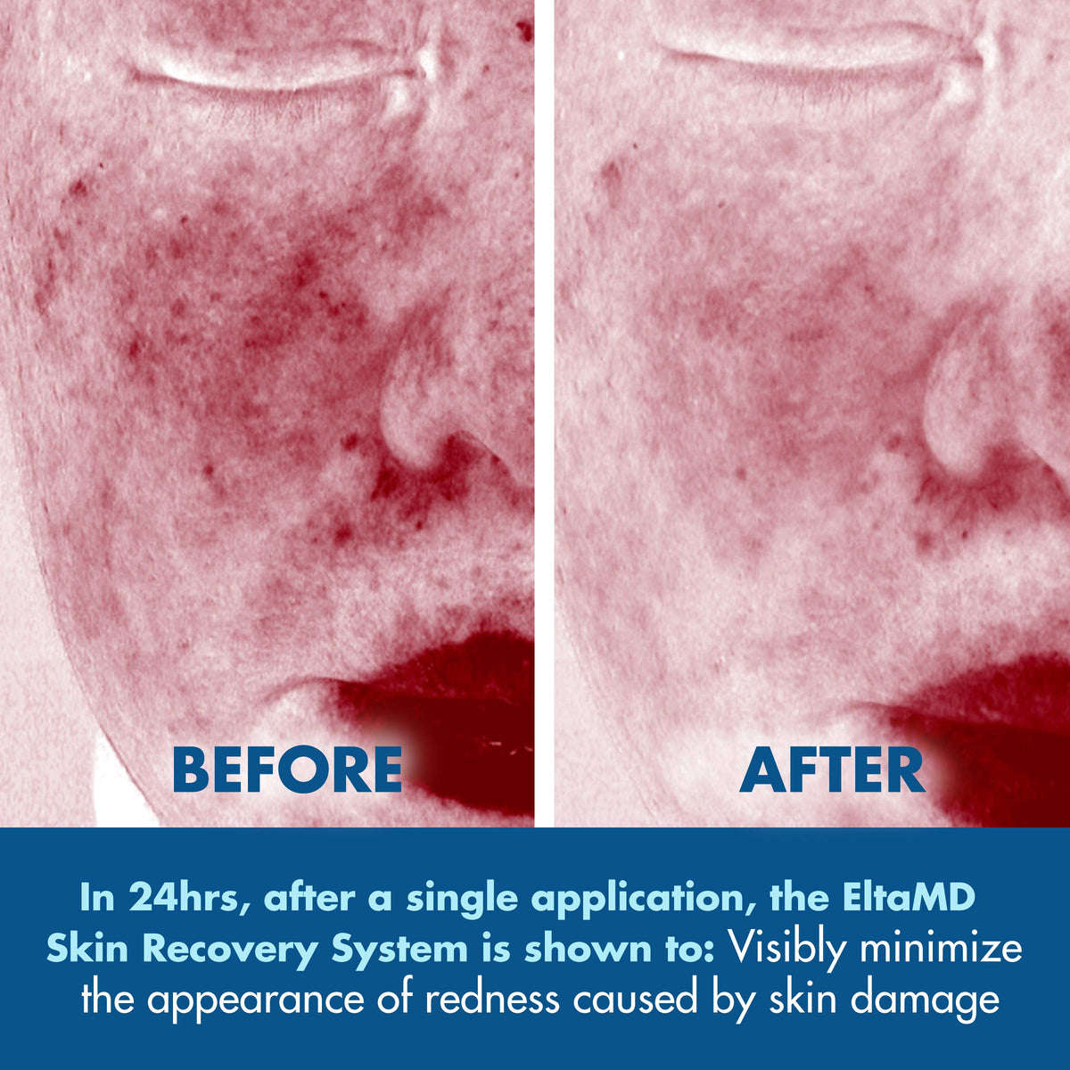 Gray EltaMD Skin Recovery System Facial Skin Care Set includes Gentle Essence Toner, Serum and Light Moisturizer, 3-Piece Set