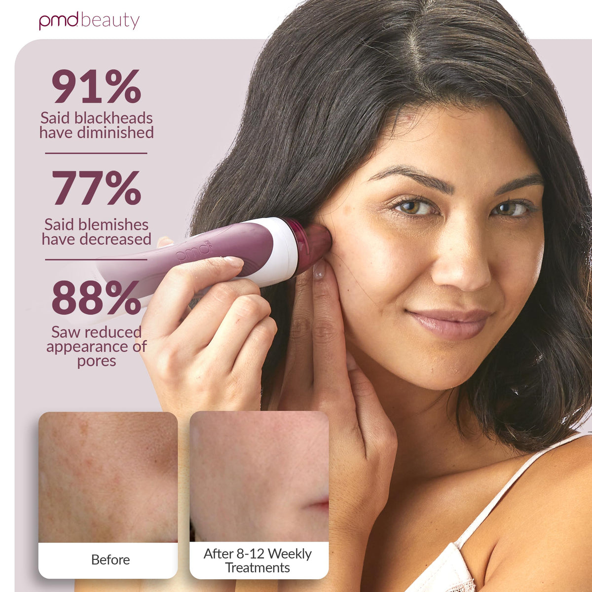 Light Gray PMD Beauty Personal Microderm Pro - At-Home Use, Facial Exfoliator Tool, Microdermabrasion Machine Kit for Face and Body Skincare